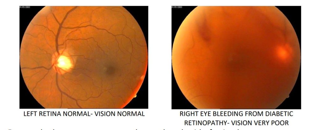 RIIO To Introduce Screening For Diabetic Retinopathy On Car Free Day ...